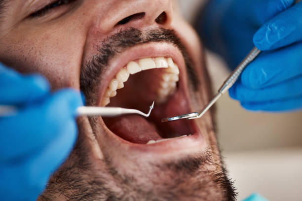 Best Emergency Dentist for Lost Fillings or Crowns in South Yarmouth, MA